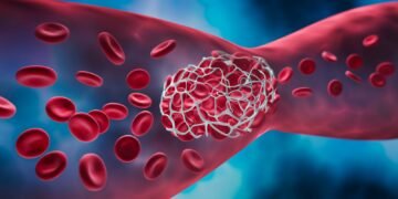Fibrilația Atrială: O provocare în sănătatea cardiovasculară
