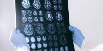 Semnele care arată că suferiți de o afecțiune neurologică gravă